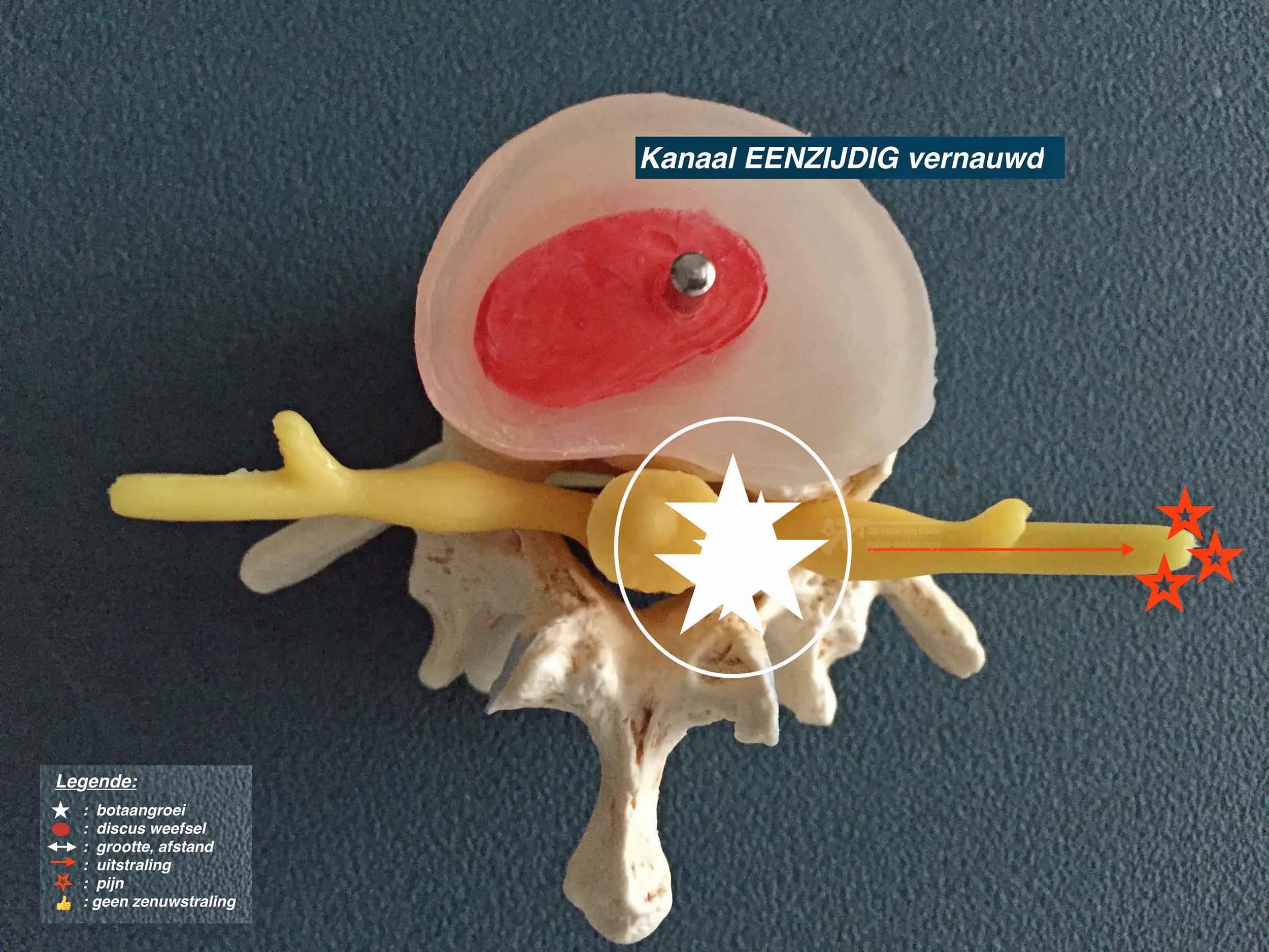 【コーウィン様用】NERVE / Fracture Sciatica & Arm Pain | Nerve Pain Causes & Solutions — Spine